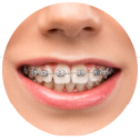 Metal Braces