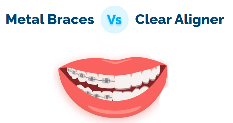 Metal vs Clear Aligner