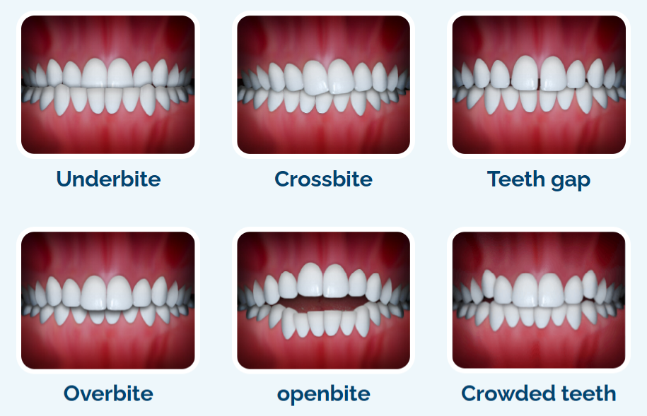 Problems Clear Aligners Solve