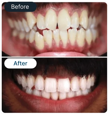 clear-Aligner-result-img-1