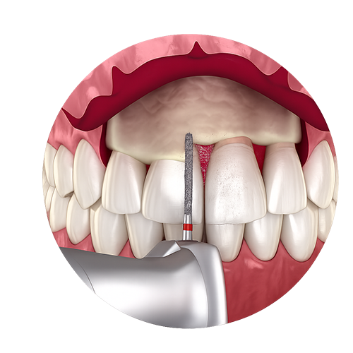 Crown Lengthening Kerala — gum and bone reshaping