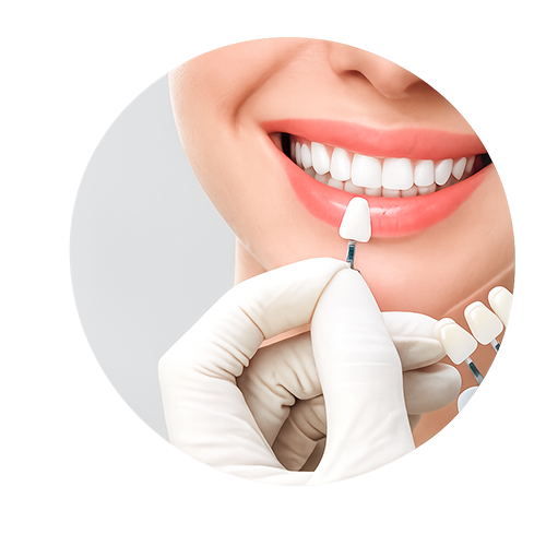 Dental Veneers and Crowns gum aesthetics Kerala