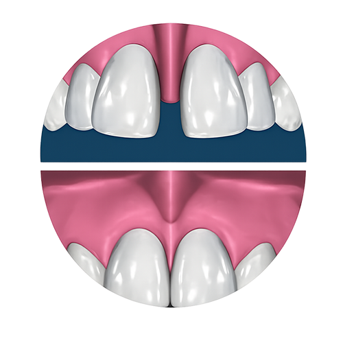 Frenectomy Kerala — frenum removal gum treatment