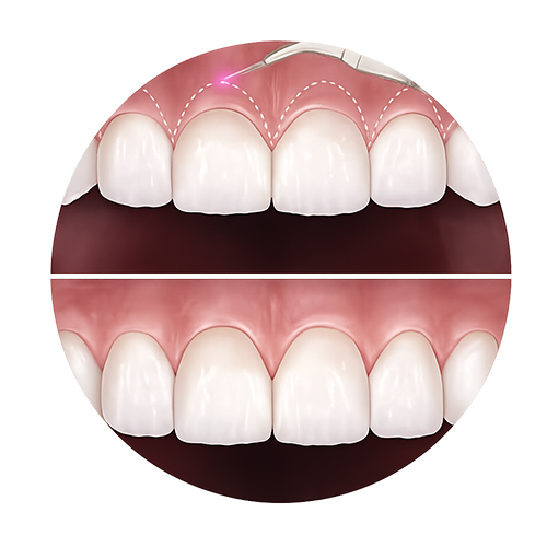 Gum Contouring treatment Kerala — Smilebetter