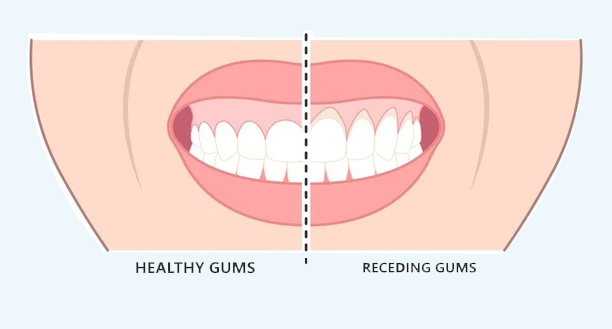 Why gum aesthetics treatment in Kerala