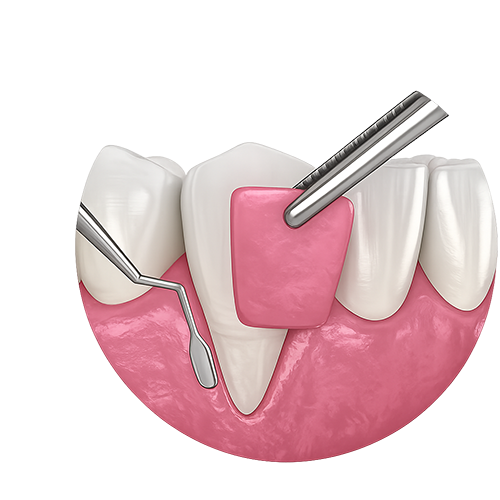Gum Grafting Kerala — receding gums treatment