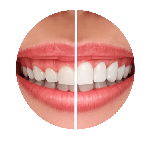 Lip Repositioning Surgery Kerala — severe gummy smile
