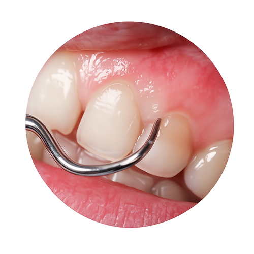 Soft Tissue Augmentation Kerala gum treatment