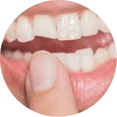 Cracked or Chipped Off Teeth