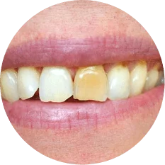 Discoloured or Stained Teeth
