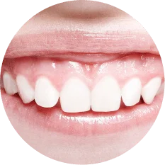 Gummy Smile