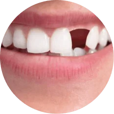 Missing Teeth