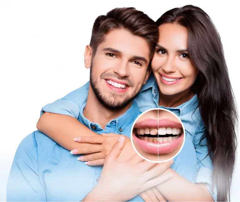 Before and after smile makeover
