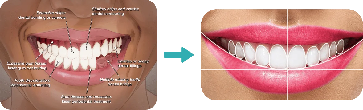 How Smile Makeover Works