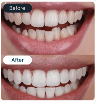 Smile Result